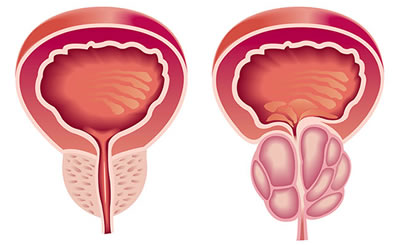 Blog - Povečana prostata, prostatitis - pomagajte si s konopljino smolo - slika 1